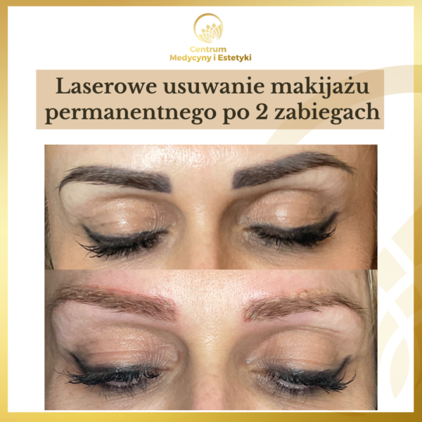 Laserowe usuwanie tatuażu / makijażu permanentnego